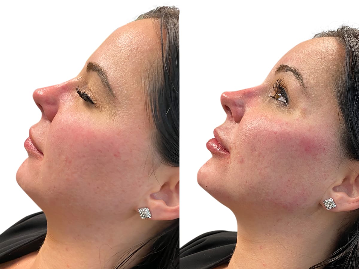 Liquid Facelift Before & After Gallery - Patient 416970 - Image 2