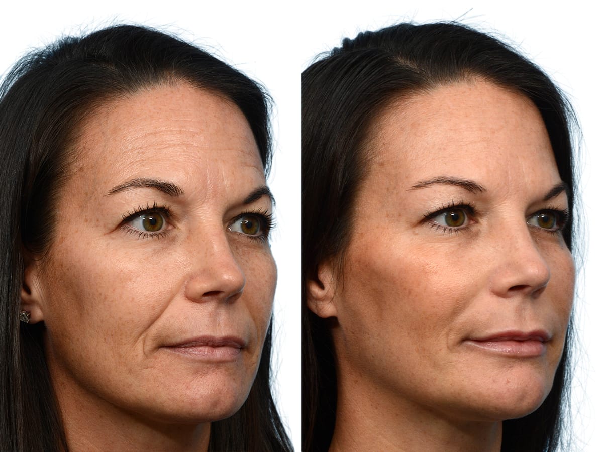 Liquid Facelift Before & After Gallery - Patient 268361 - Image 3