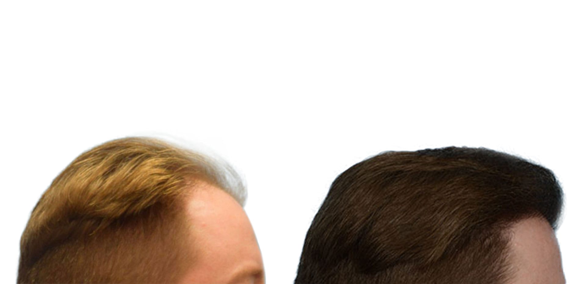 Hair Restoration  Before & After Gallery - Patient 287793 - Image 4