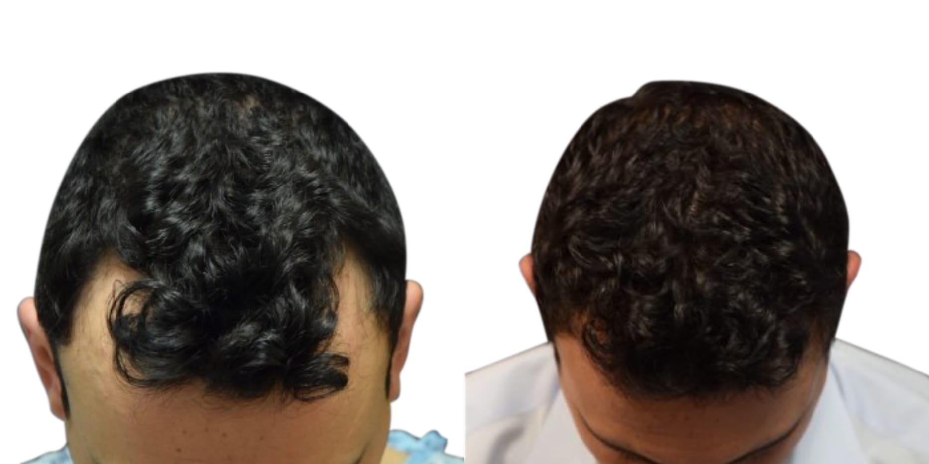 Hair Restoration  Before & After Gallery - Patient 427124 - Image 1