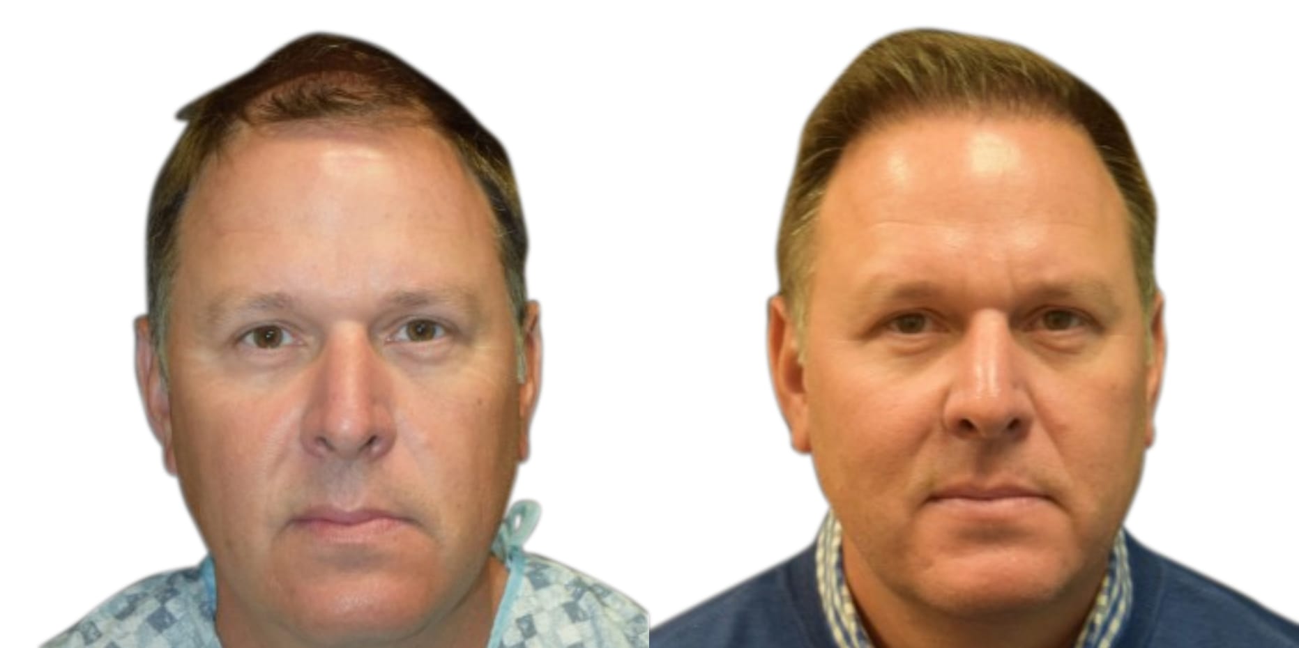 Hair Restoration  Before & After Gallery - Patient 369793 - Image 2