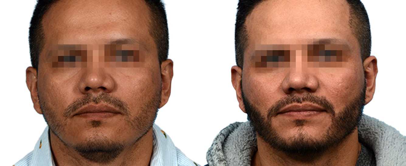 Hair Restoration  Before & After Gallery - Patient 250148 - Image 1