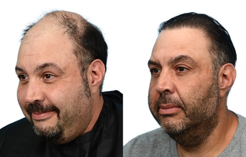 Hair Restoration  Before & After Gallery - Patient 755503 - Image 3