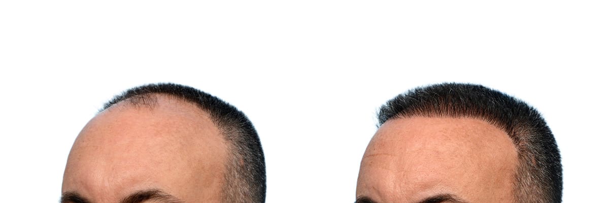 Hair Restoration  Before & After Gallery - Patient 337969 - Image 3