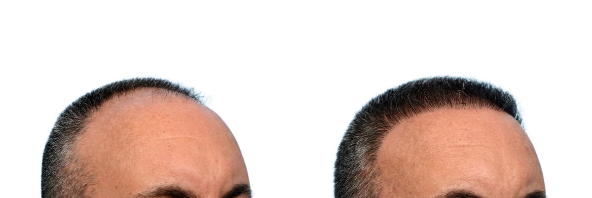 Hair Restoration  Before & After Gallery - Patient 337969 - Image 4