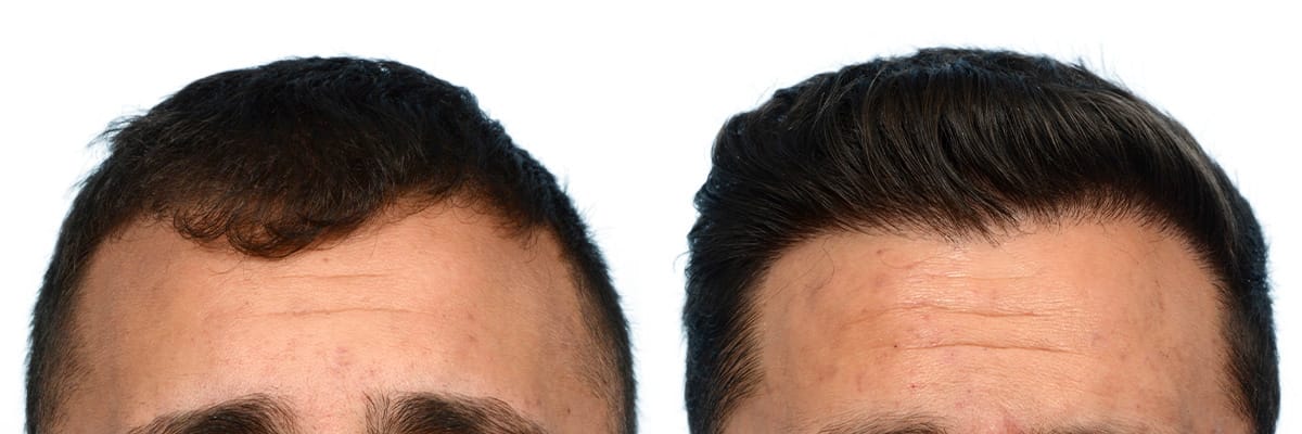 Hair Restoration  Before & After Gallery - Patient 266399 - Image 1