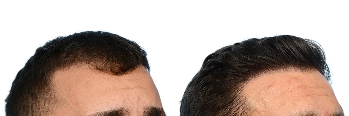 Hair Restoration  Before & After Gallery - Patient 266399 - Image 4