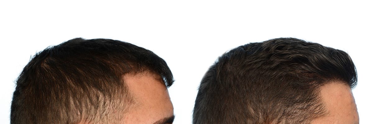 Hair Restoration  Before & After Gallery - Patient 266399 - Image 5