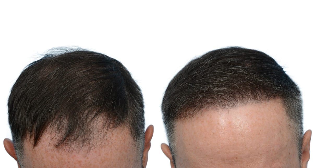 Hair Restoration  Before & After Gallery - Patient 366613 - Image 1