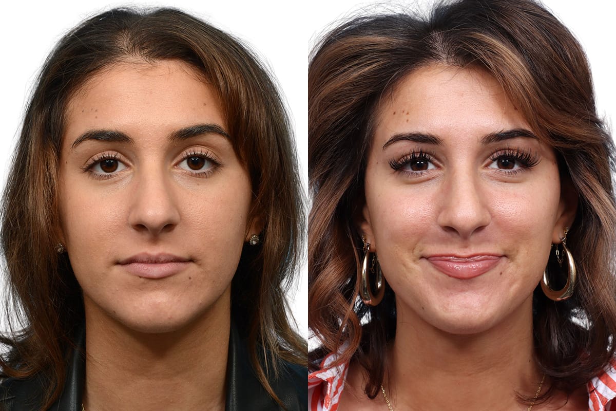 Hair Restoration  Before & After Gallery - Patient 469017 - Image 1