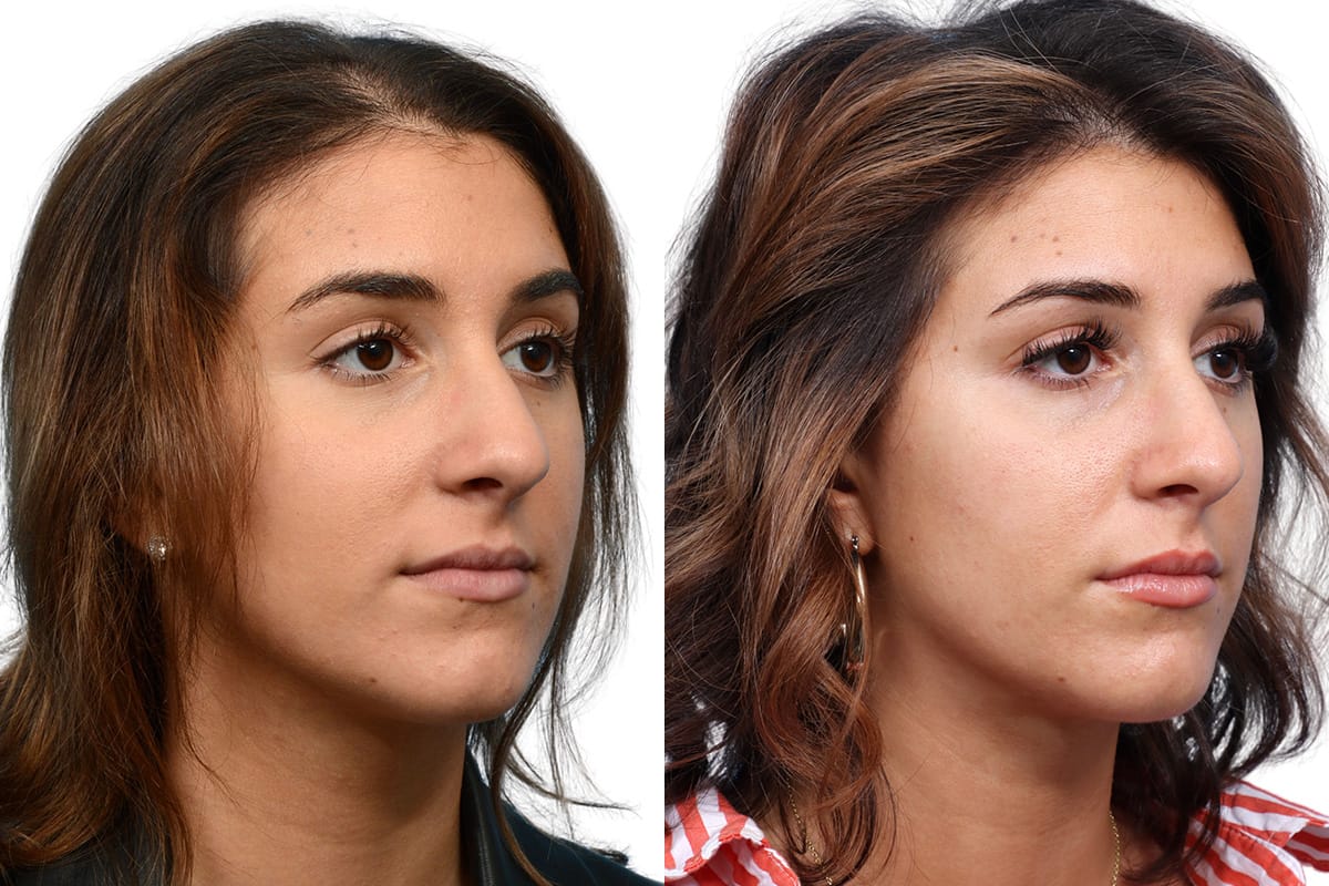 Hair Restoration  Before & After Gallery - Patient 469017 - Image 2