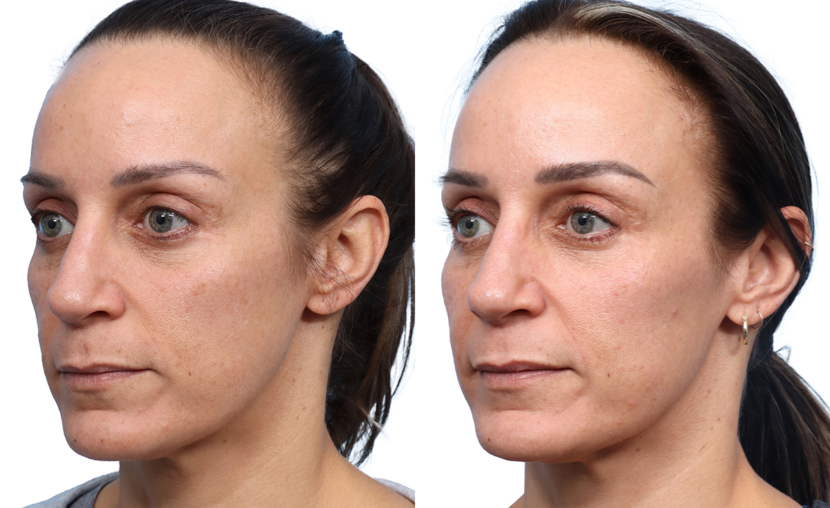 Cool Peel Before & After Gallery - Patient 175623 - Image 2