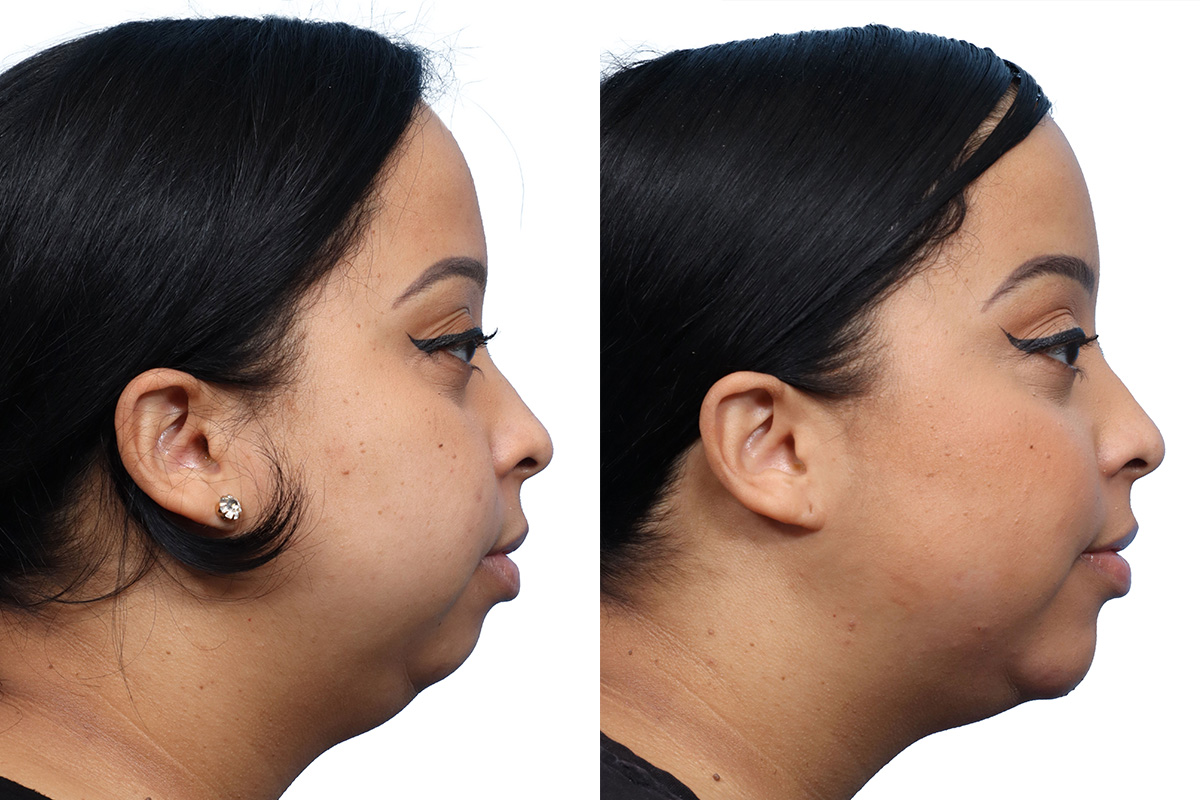 Jawline Filler Before & After Gallery - Patient 409240 - Image 1
