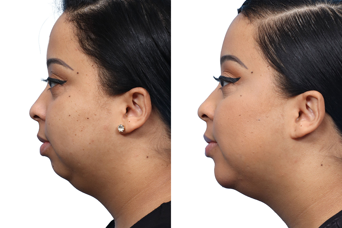 Jawline Filler Before & After Gallery - Patient 409240 - Image 2