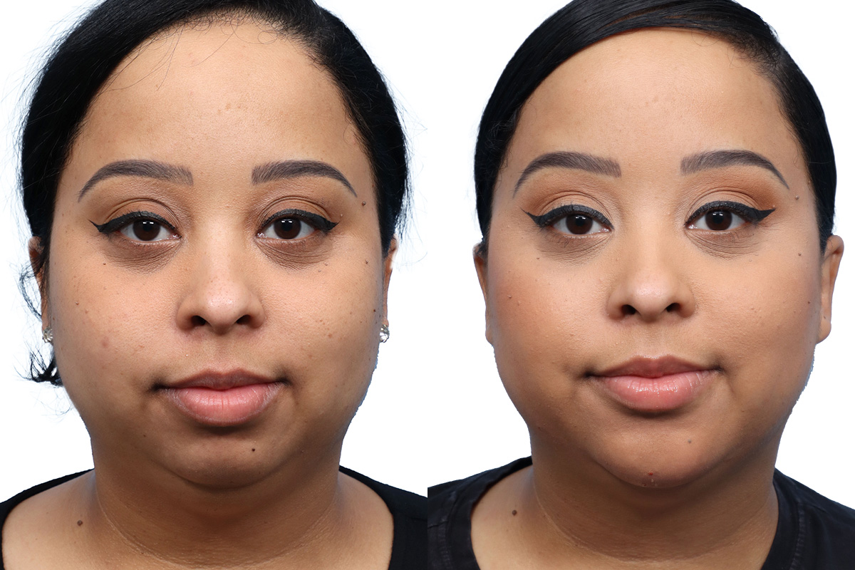 Jawline Filler Before & After Gallery - Patient 409240 - Image 3