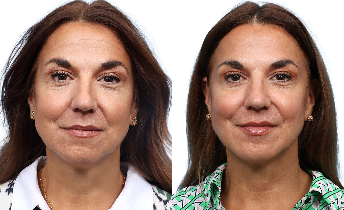Liquid Facelift Before & After Gallery - Patient 427933 - Image 1