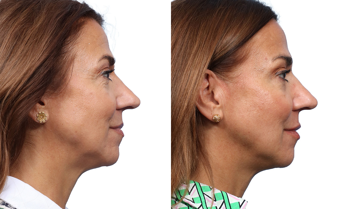 Liquid Facelift Before & After Gallery - Patient 427933 - Image 2