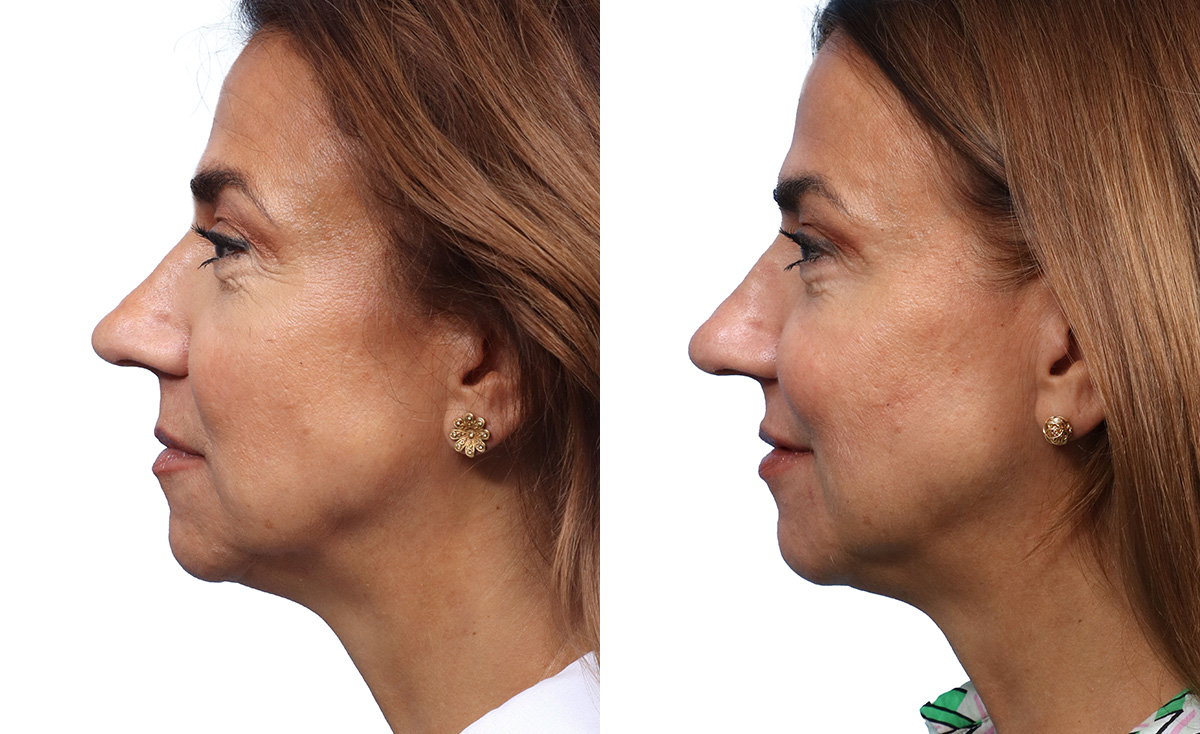 Liquid Facelift Before & After Gallery - Patient 427933 - Image 3