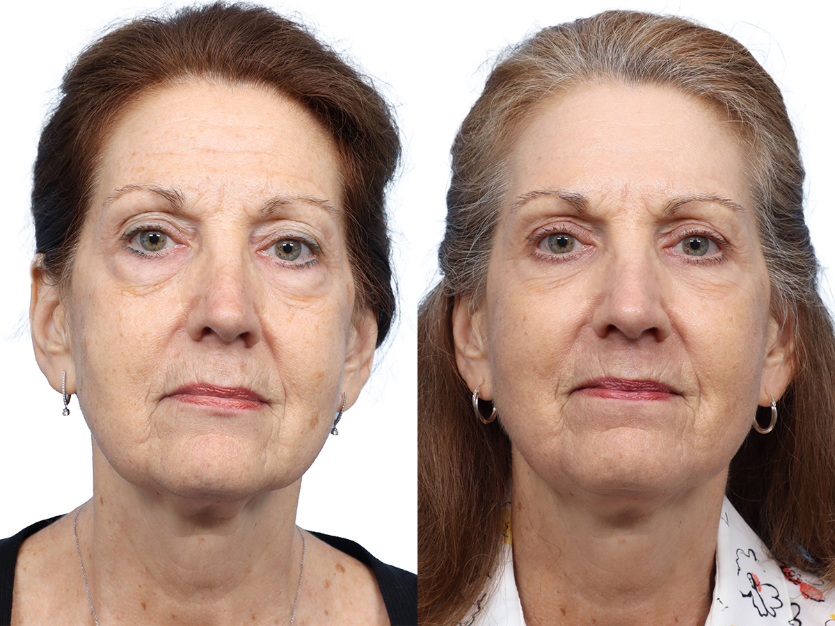 CO2 Laser Before & After Gallery - Patient 162157 - Image 3
