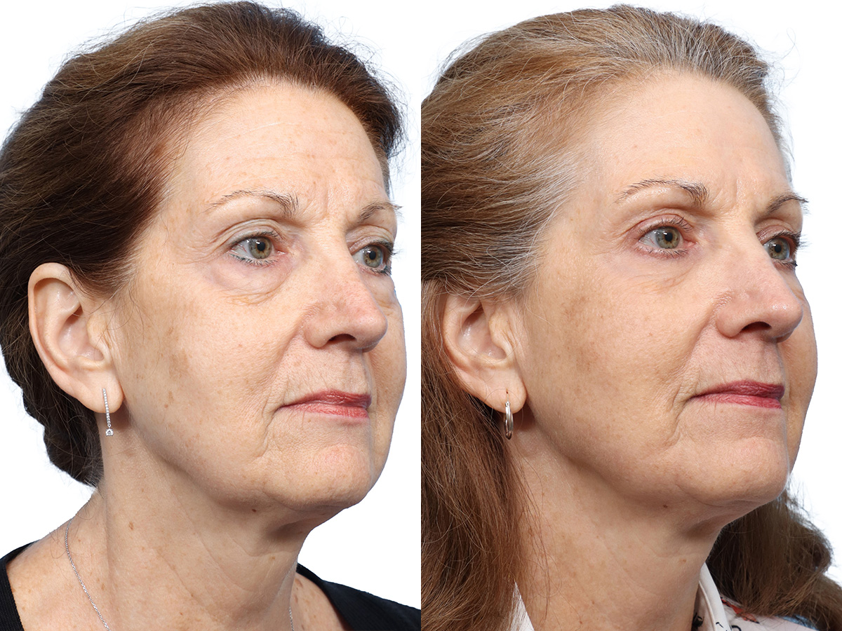 CO2 Laser Before & After Gallery - Patient 162157 - Image 2