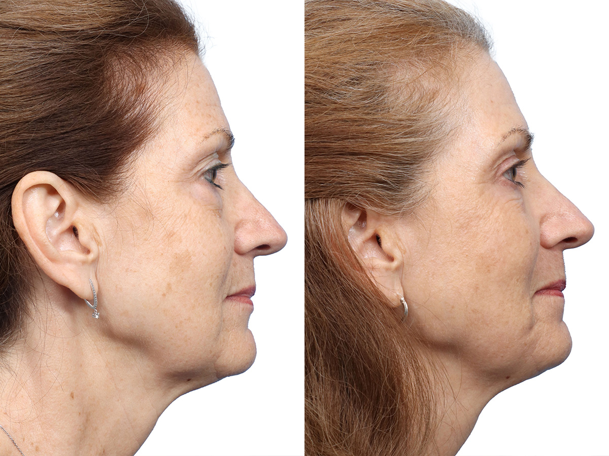 CO2 Laser Before & After Gallery - Patient 162157 - Image 1