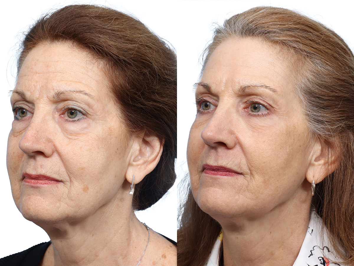 CO2 Laser Before & After Gallery - Patient 162157 - Image 4
