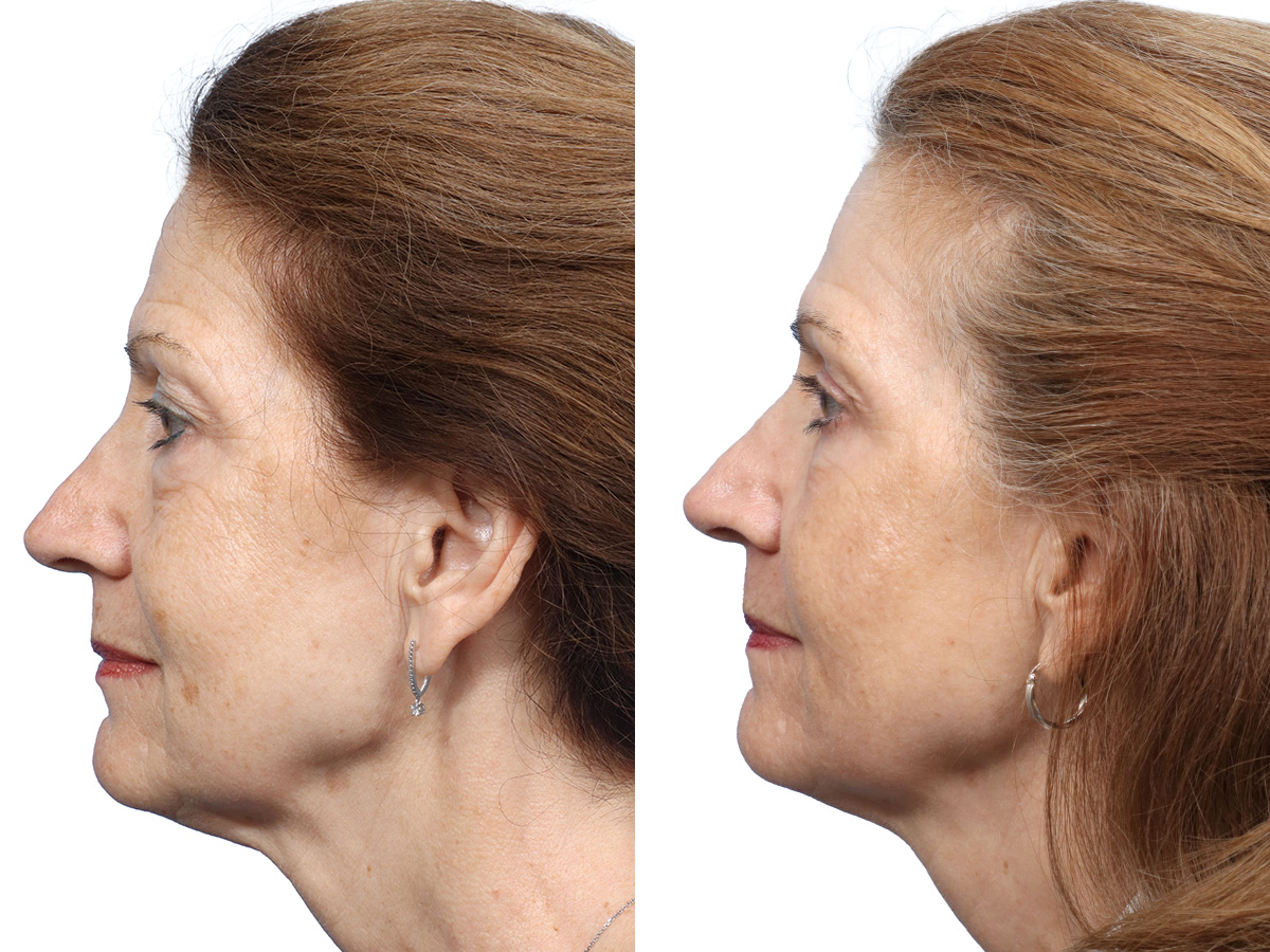 CO2 Laser Before & After Gallery - Patient 162157 - Image 5