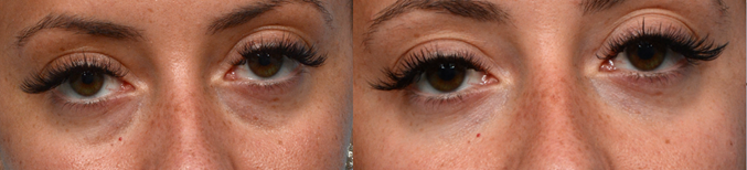 Tear Trough Filler Before & After Gallery - Patient 256284 - Image 1