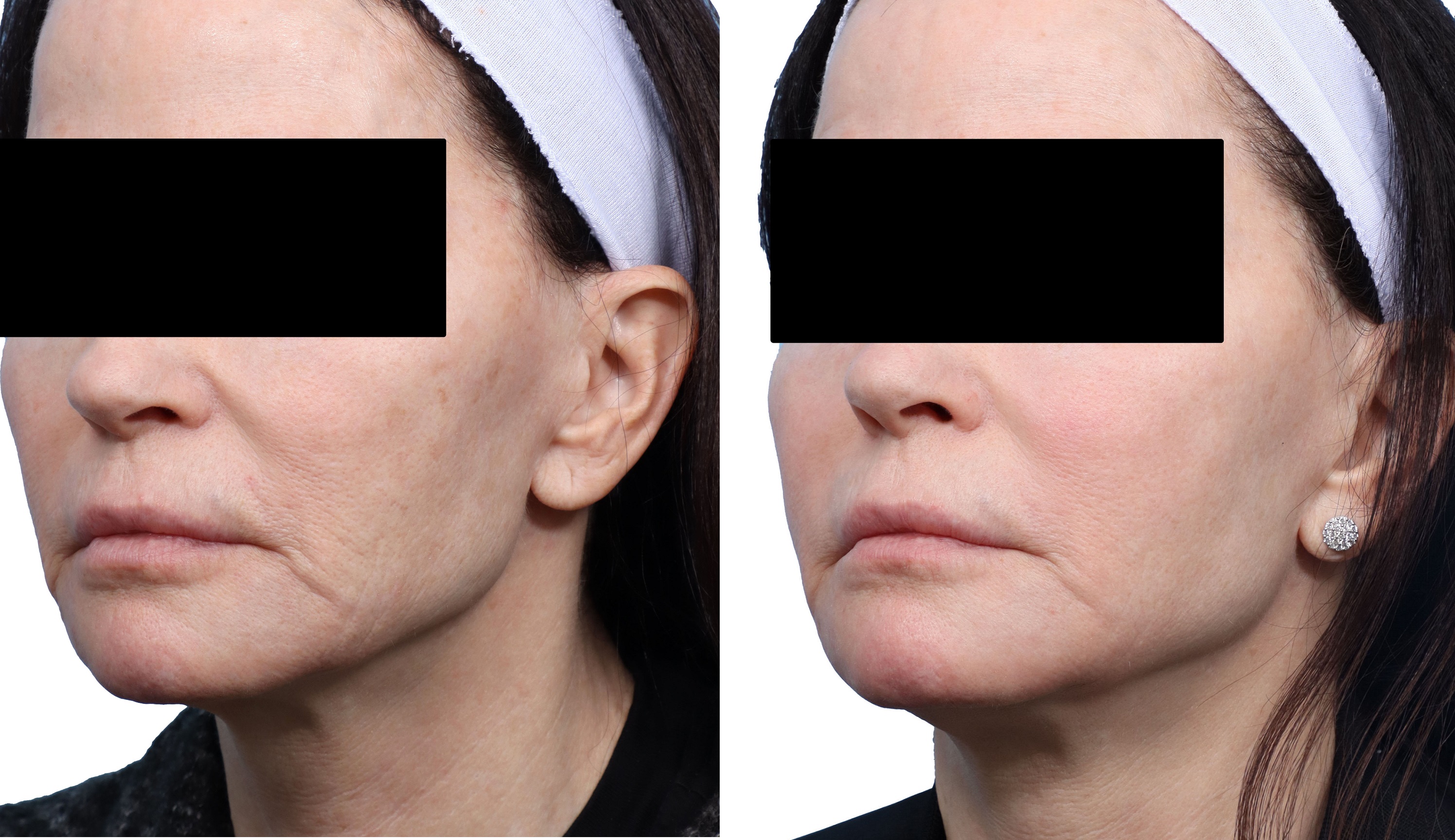 Cool Peel Before & After Gallery - Patient 855851 - Image 1