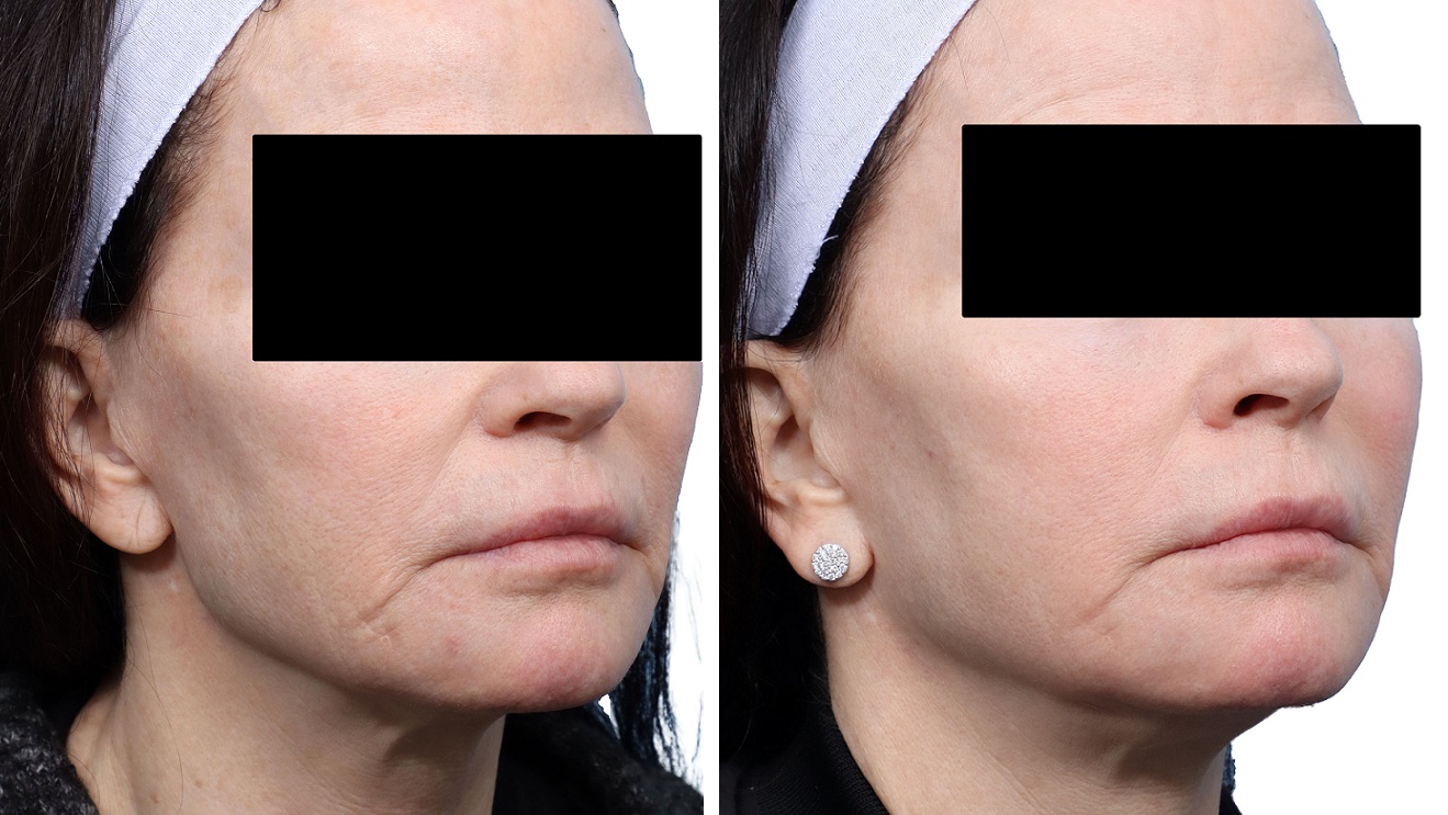 Cool Peel Before & After Gallery - Patient 855851 - Image 2