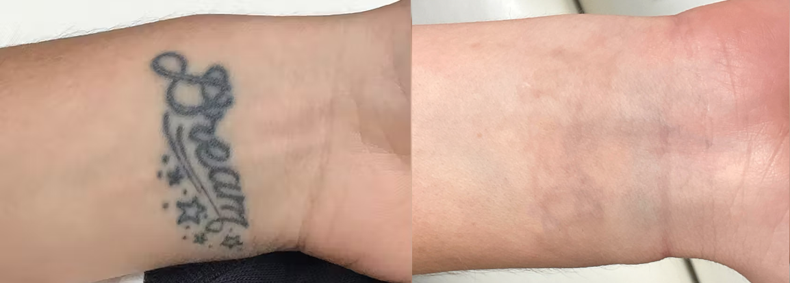 Tattoo Removal Before & After Gallery - Patient 164316 - Image 1
