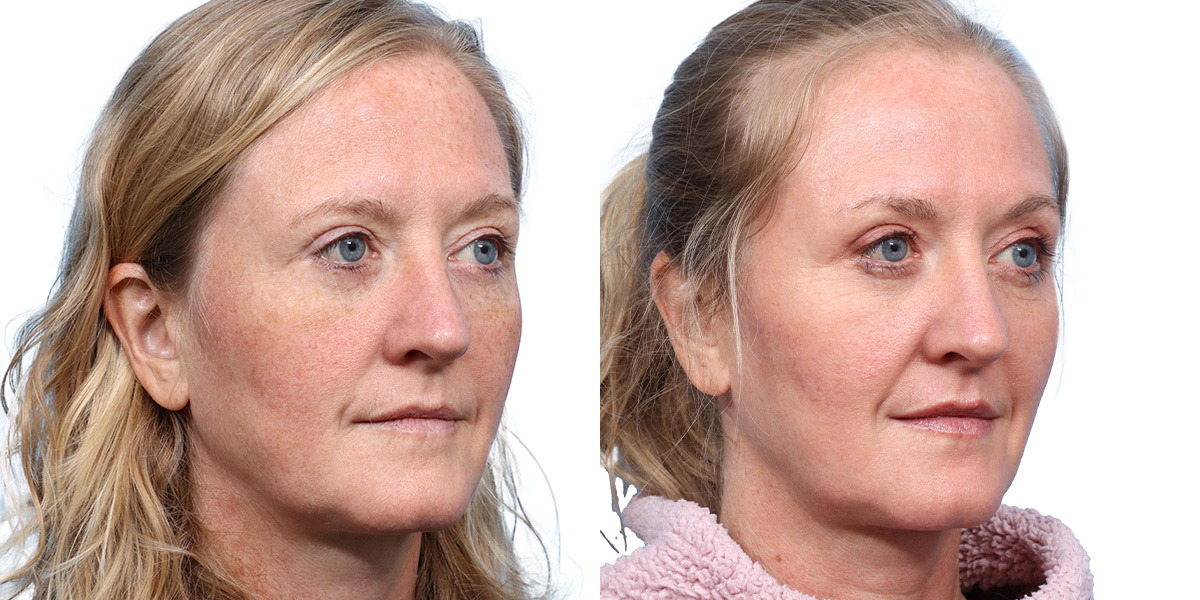 CO2 Laser Before & After Gallery - Patient 116297 - Image 1
