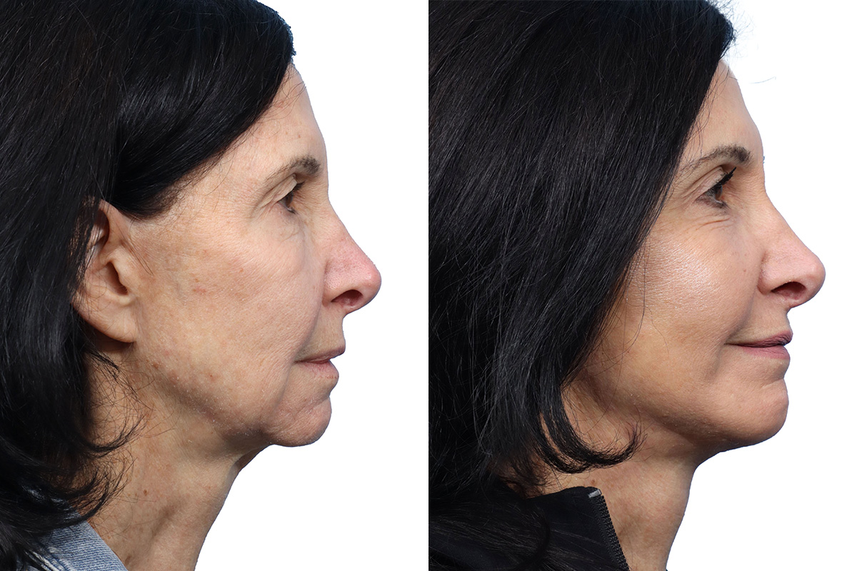 CO2 Laser Before & After Gallery - Patient 428445 - Image 1