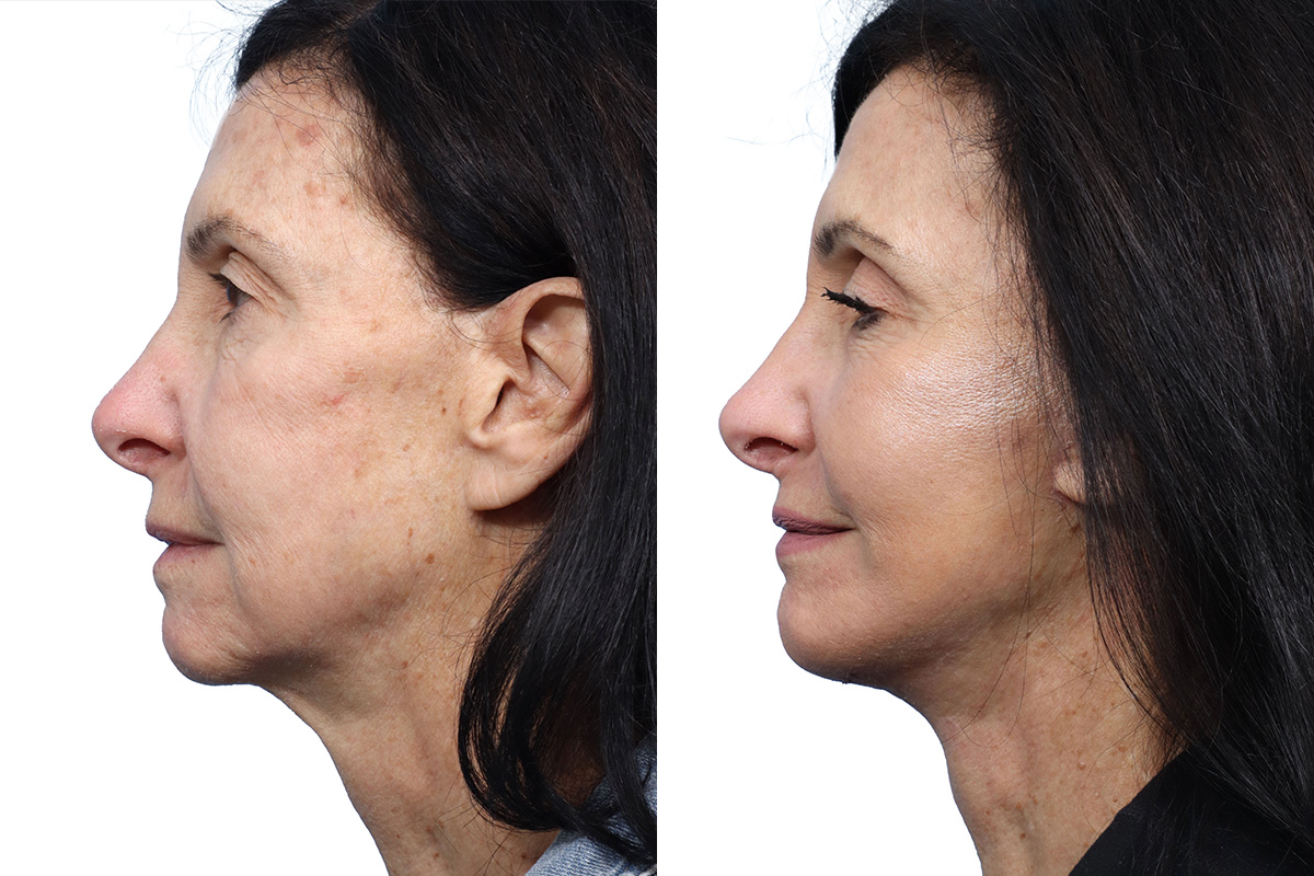 CO2 Laser Before & After Gallery - Patient 428445 - Image 2