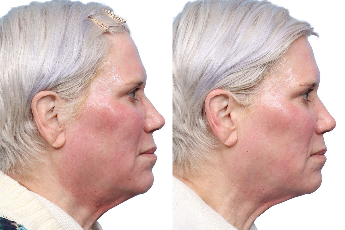 Glacial Skin Rx  Before & After Gallery - Patient 281877 - Image 2
