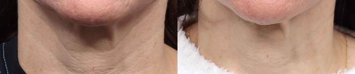 Cool Peel Before & After Gallery - Patient 375995 - Image 1