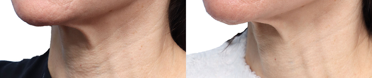 Cool Peel Before & After Gallery - Patient 375995 - Image 3