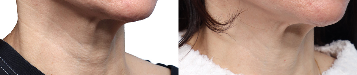 Cool Peel Before & After Gallery - Patient 375995 - Image 2