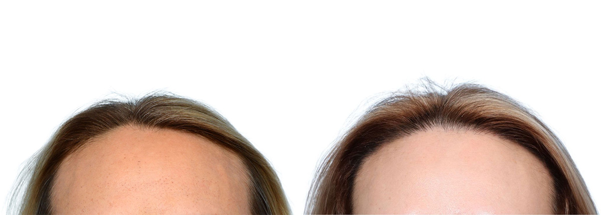 FUT Hair Transplant Before & After Gallery - Patient 107310 - Image 2