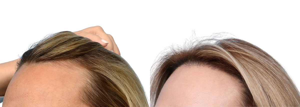 FUT Hair Transplant Before & After Gallery - Patient 107310 - Image 4