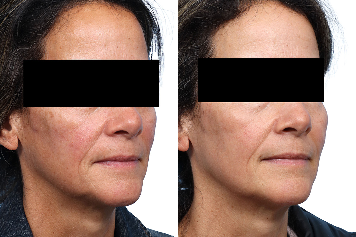 Cool Peel Before & After Gallery - Patient 316670 - Image 1