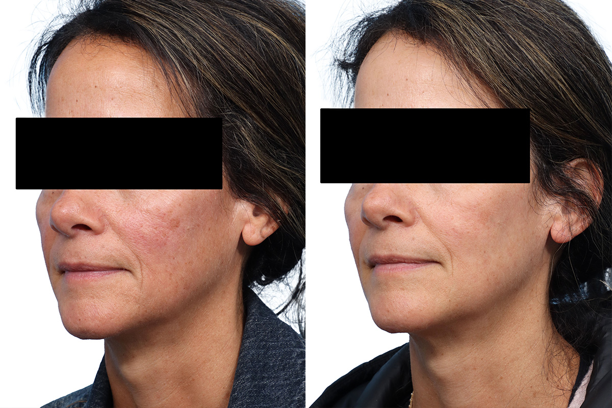 Cool Peel Before & After Gallery - Patient 316670 - Image 2