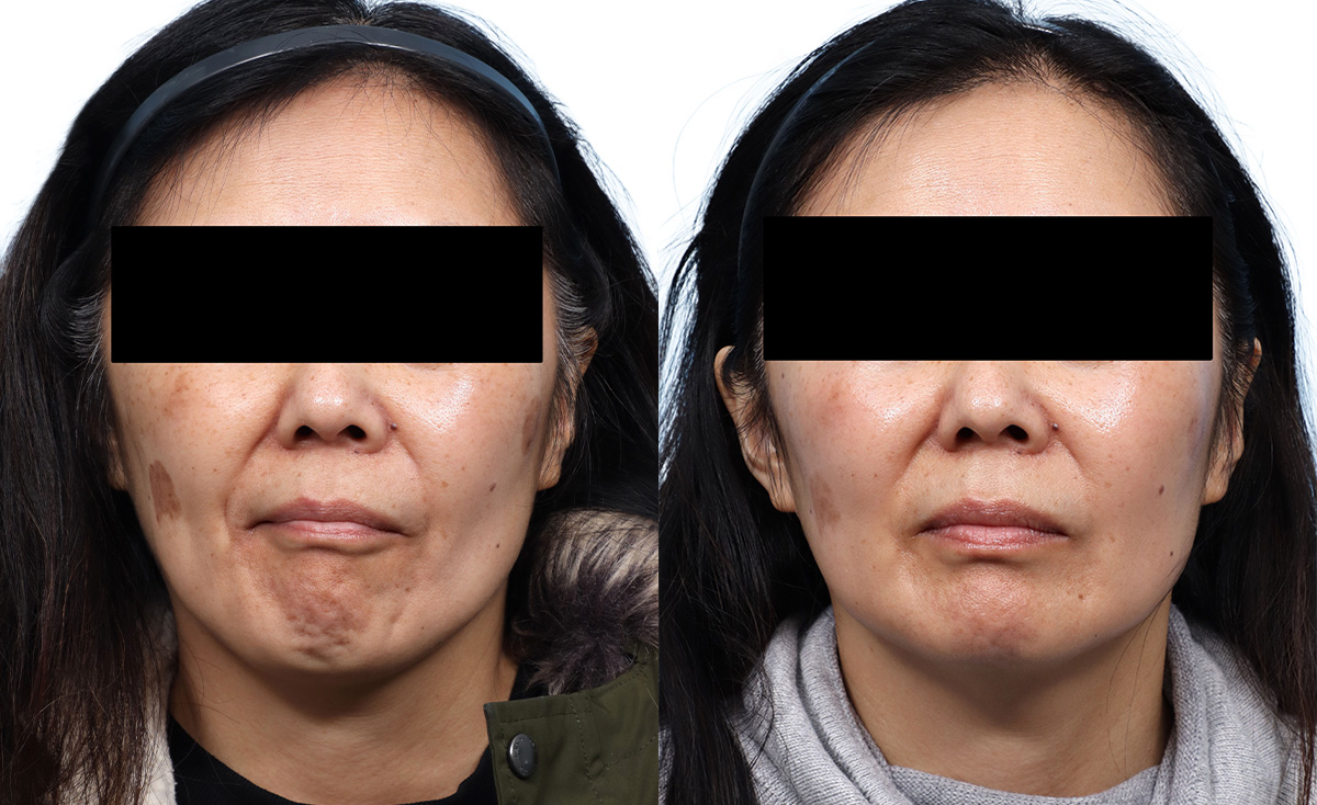 Chemical Peels Before & After Gallery - Patient 426041 - Image 1