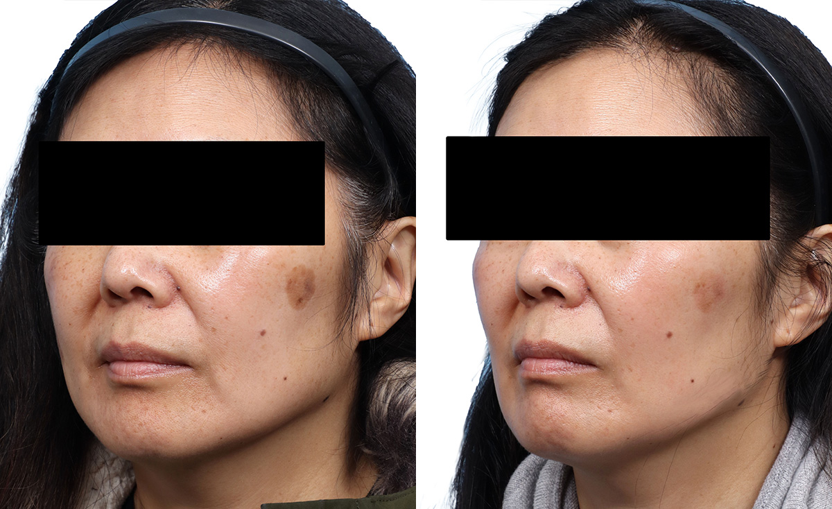 Chemical Peels Before & After Gallery - Patient 426041 - Image 3