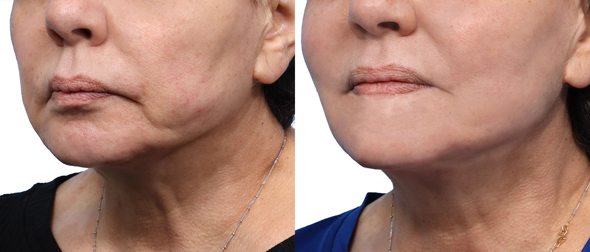 QuantumRF Before & After Gallery - Patient 417241 - Image 2