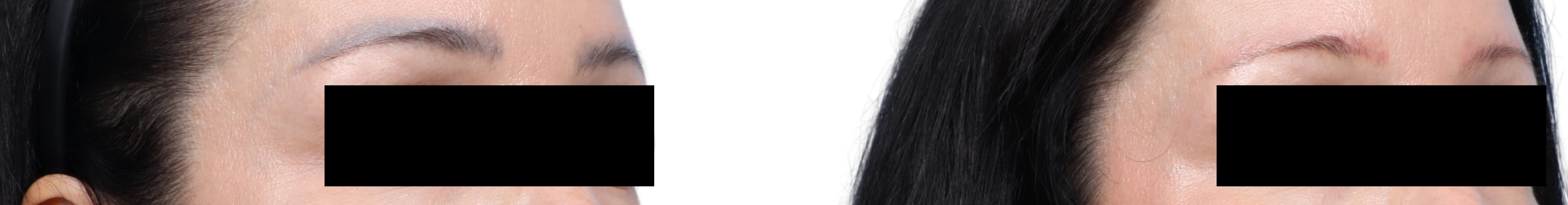 Tattoo Removal Before & After Gallery - Patient 226467 - Image 2