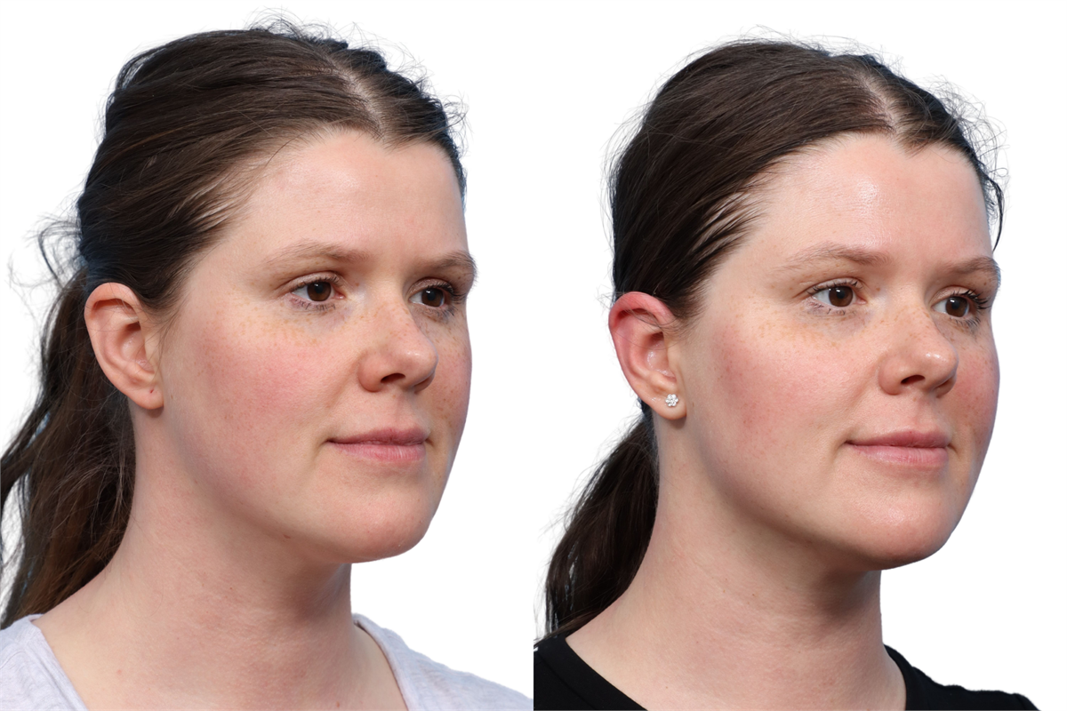 XERF Before & After Gallery - Patient 709492 - Image 1