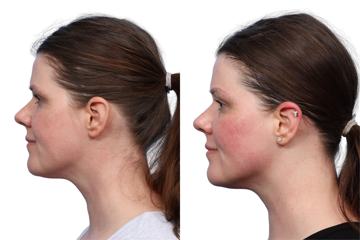 XERF Before & After Gallery - Patient 709492 - Image 2