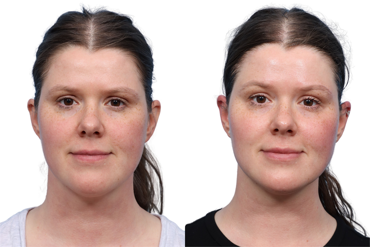 XERF Before & After Gallery - Patient 709492 - Image 3