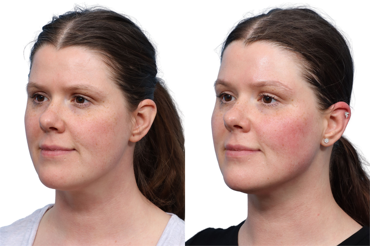 XERF Before & After Gallery - Patient 709492 - Image 4